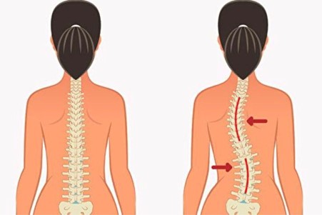 Punca Scoliosis: Kenapa Tulang Belakang Boleh Membengkok